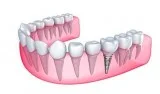 Dental Implants Waterloo  Eastbridge Dental Care