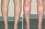 Calf Implant Cost in India  Vaidam Health