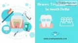 Braces Treatment Cost in South Delhi