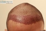 Are you Looking for FUE Hair Transplant Clinic in Delhi