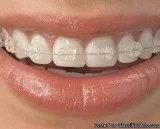 Replace Your Damaged Teeth with Dental Implant at US Dental Ahme