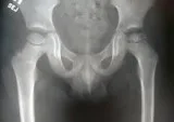 What is the treatment for Perthes disease