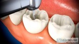 Root Canal Treatment - Dent Cure