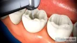 Root Canal Treatment - Dent Cure