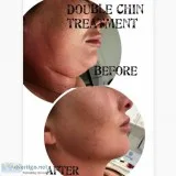 ABDOMINOPLASTY (TUMMY TUCK)