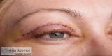 The Salient Features of Cosmetic Eyelid Lift Surgery MD