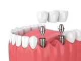 Bridges in Dentistry
