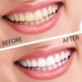 General Tooth Whitening Service at BEDC