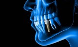 Lewiston Dental Implants  Androscoggin Dental Group