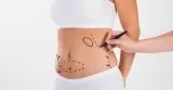 Which Is The Best Abdominoplasty Treatment In Delhi