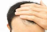 Best Doctor for Hair Fall Treatment in Delhi