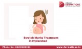 Stretch Markers Treatment In Hyderabad