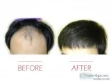 FUE vs. FUT Comparing Hair Transplantation Methods  North Shore 