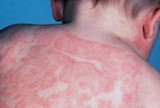 Skin Allergy - Eczema Treatment in Delhi