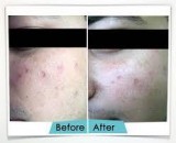 Wosyet Vit&aacutel&trade Scar Reduction in Gurgaon