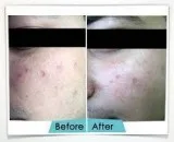 Wosyet Vit&aacutel&trade Scar Reduction in Gurgaon