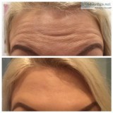 Wrinkle Relaxers Injections in Perth  Beneaththeskin.net