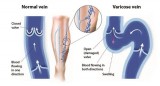 Leg pain swelling cramps  Laser Vein Treatment in Chicago