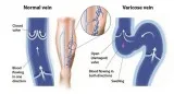 Leg pain swelling cramps  Laser Vein Treatment in Chicago