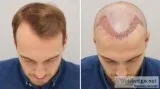 Best Hair Transplant Surgery UK - Revive Hair and Skin Clinic