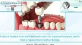 Revive Your Beautiful Teeth And Smile With Dental Implants