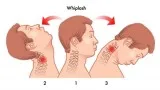 Accident Whiplash Treatment