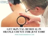 Get Skin Tag Removal in Orange County for just 100