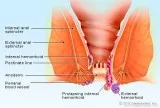 piles treatment in Mumbai without operation in Mumbai