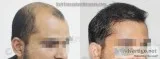 Get the best Hair Transplant in Faridabad at Medispa
