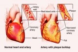 Heart Double Valve Replacement Cost in India  Vaidam Health
