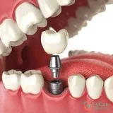 Dental Implant Dentistry In Roswell Georgia