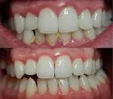 Plaque Removal Clinic in Mumbai