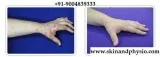 TREATMENT FOR BURN MARKS