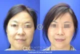 Face Lift Surgery in Orange County