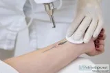 SMUK - Laser Treatments for Tattoo Removal in India