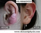 BEST TREATMENT FOR KELOID