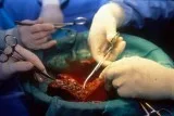 Senior Liver Transplant Doctor in New Delhi