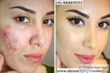BEST TREATMENT FOR ACNE  PIMPLE