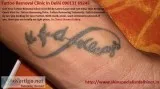 Tattoo Removal Clinic In Delhi