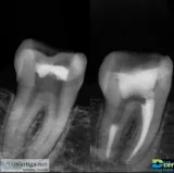 Root Canal 280 cualquier diente