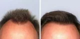 Hair Transplant Treatment in Kochi   Body Hair Transplant in Coc