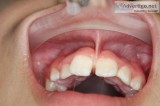 Tongue Tie Treatment Sydney