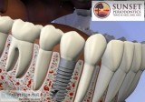 Dental Implant in Columbia Lexington SC