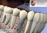Dental Implant in Columbia Lexington SC
