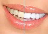 Cosmetic dentist in Gurgaon Palam Vihar  Dr Bhatia s Clinic