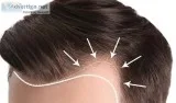 Find here To Best Hair transplant center in Mumbai Andhari West