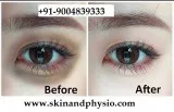 UNDER EYES DARK CIRCLES