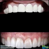 Zirconia Crowns  400
