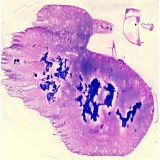 Find the Best Cervical cytology services in Delhi NCR India
