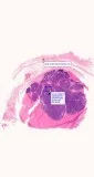 Searching for the Best Dermatopathology services in Delhi NCR In